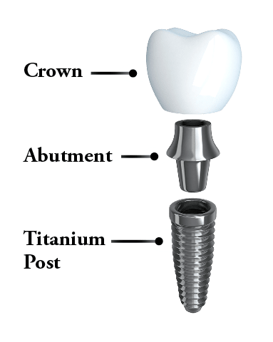 Dental Implants Huntersville, NC - Anatomy of a dental implant - post, abutment, and crown.