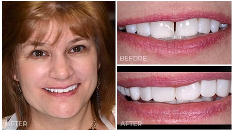 Karen, who's an actual patient of NorthStar Dentistry for Adults and is now in our Smile Gallery