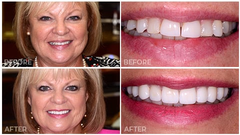 Kathy, who receive porcelain veneers from NorthStar Dentistry for Adults and is now in our Smile Gallery