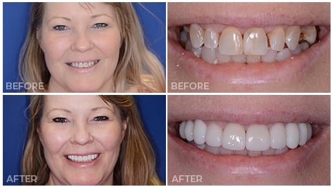 Kim, who receive porcelain veneers from NorthStar Dentistry for Adults and is now in our Smile Gallery