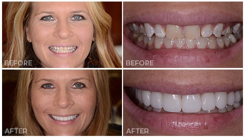 Laura, who receive porcelain veneers from NorthStar Dentistry for Adults and is now in our Smile Gallery