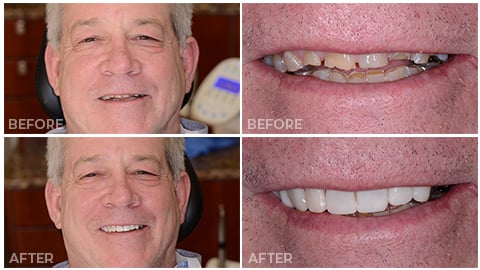 An actual patient of NorthStar Dentistry for Adults and is now in our Smile Gallery