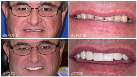 An actual patient of NorthStar Dentistry for Adults and is now in our Smile Gallery