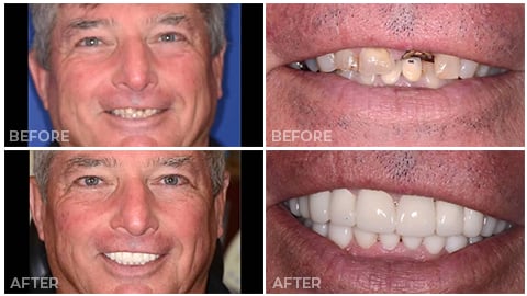 An actual patient of NorthStar Dentistry for Adults and is now in our Smile Gallery