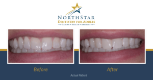 Patient smile before and after dental bonding treatment.